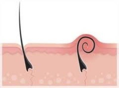 REMOVE HAIRS INCARNATED REMOVE HAIRS INCARNATE